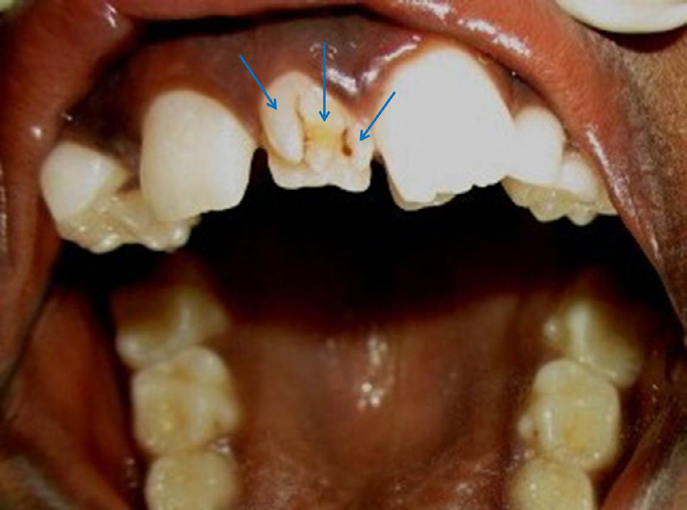 Figure 1: Intraoral Photograph Showing Maxillary Mesiodens with Labial Three (Triple) Talon Cusps (Blue Arrows).