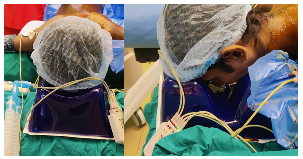 Figure 1: Silicone gel pad placed under the forehead region in the prone position.