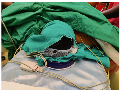 Figure 2: Silicone gel pad placed under scalp in supine position.