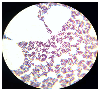 Figure 3: Staphylococcus aureus seen after gram staining (X100).