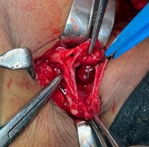 Figure 2: Enucleated Schwannoma in Brachial.