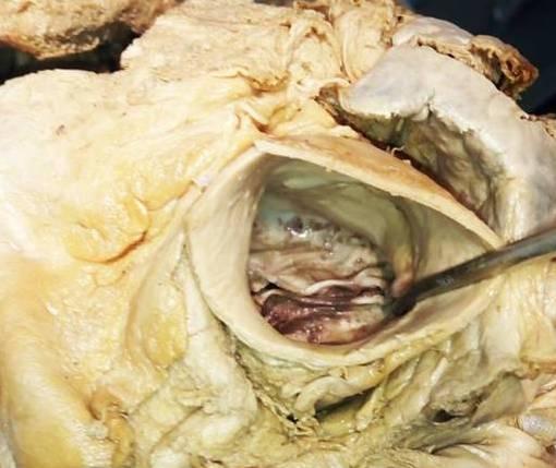 Figure 1: Picture of bicuspid aortic valve where both cusps are linear in appearance.