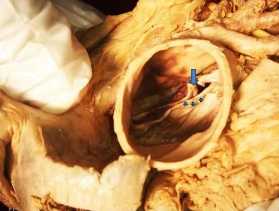 Figure 3: Picture of bicuspid aortic valve with calcification (*) and friable leaflet (arrow). Scholz, et al. reported that 24% of the BAV patients in their study had a left dominant cardiac circulation [15]. Hutchins, et al. found a higher incidence of left dominance, 29%, in postmortem angiography among the patients with the BAVs in their study [16]. It has been recognized that the BAV demonstrates abnormal leaﬂet motion, including folding or wrinkling of the valve tissue and increased leaﬂet doming during the cardiac cycle. This may result in increased currents of turbulence even when the leaﬂets are not stenotic [8]. Collins, et al. reported a prevalence of infective endocarditis of 1.5% among patients with the BAVs in his study, while we observed a prevalence of 4.11% [13]. The BAV, appearing on gross examination as an aortic valve with two cusps, has clinical relevance and has gained increasing interest in the medical community from a pathogenetic and especially surgical point of view.