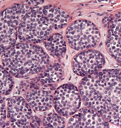 Figure 1: Pleomorphic lobular carcinoma in situ demonstrating lobular expansion with tumour cells imbued with abundant, eosinophilic cytoplasm, intracytoplasmic mucin and pleomorphic nuclei with variable outline and prominent nucleoli [5].