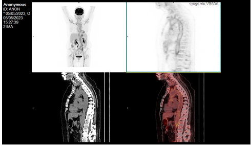 Figure 5: Hypermetabolism involving the aortic wall.