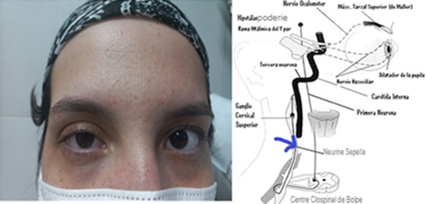 Figure 1: Mild palpebral ptosis is observed (2 mm).