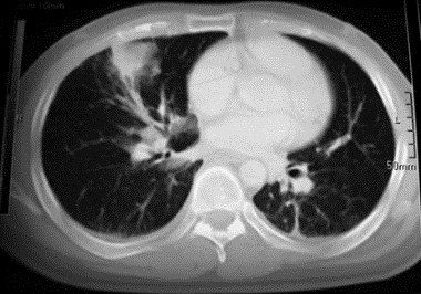 Figure 2: Contrast-enhanced chest CT: Large mass that occupies the anterior mediastinum and stenosis of the trachea and bronchial branches, the mass measures 10x15 cm transversely with predominance of the upper lobes, multiple lymphadenopathy in both lateral chains of the supra and infraclavicular neck, predominantly right.