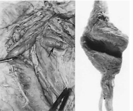 Figure 3: Compression of the stellate or superior ganglion by the internal carotid artery.