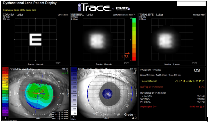 Figure 2: An example of the result using Dysfunctional Lens Patient Display module. This examination was made in the eye of 62y.o male, who started to complain with poor quality of vision in his left eye. BCVA to far distances reached 0,2 logMar, so he was disqualified to cataract removal. This examination shows how the cornea (top left panel) like also the lens (top middle panel) can influence on the quality of vision of the “E” letter. The HOA generated by the cornea reached 0,022 µm, by the Internal (lens) 0,317 µm. The final quality of vision, named as TOTAL EYE (top right panel) shows how probably a quality of vision of the patient is’s left eye. Values of HOA generated by the cornea, the entire of the eye, mainly the lens (Internal) and total HOA generated by both elements (TOTAL EYE) are seen in the bottom right panel.