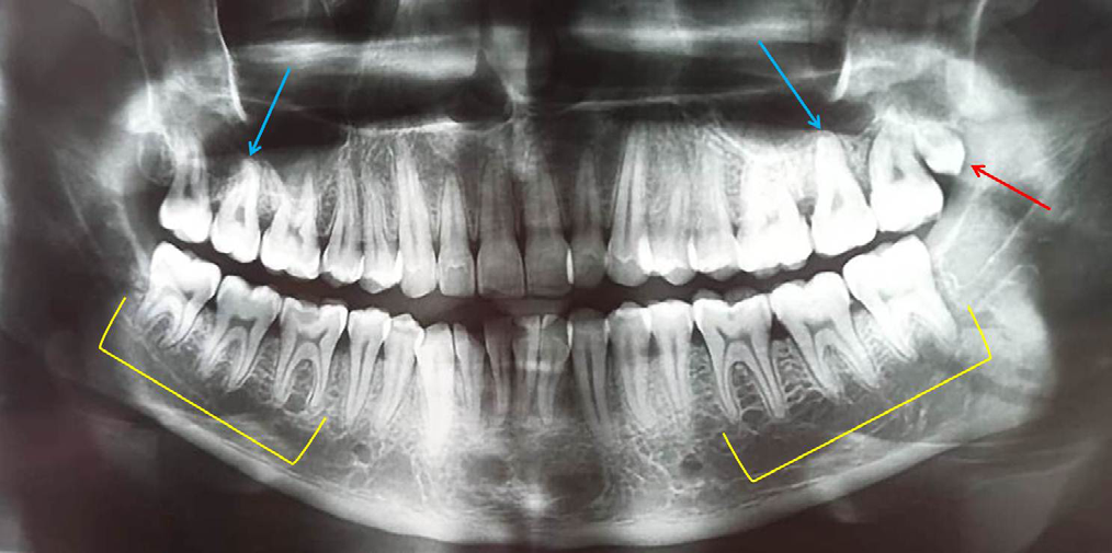 Figure 1: Radiograph Showing Fourth Molar (Distomolar) in the Maxillary Left Quadrant (Red Arrow), Rhyzomicroly (Sra) Involving Mandibular Right and Left First, Second and Third Molars (Yellow Brackets) with 1:1 Crown Root Ratio and Pyramidal Roots Involving Maxillary Right and Left Second Molars (Blue Arrows).