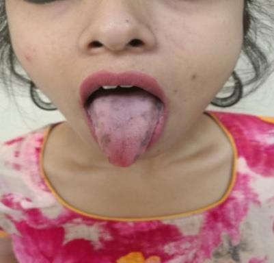 Figure 1: Hydroxyurea stopped for 2 weeks after which the pigmentation resolved, see Figure 2.