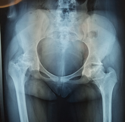 Figure 4: Preoperative pelvic Rx of a 20-year-old female patient with SS sickle cell disease who presented with bilateral ONTF.