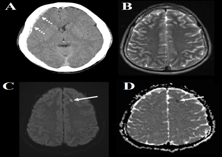 Figure 1: A 27-year-old male patient was involved in a MVA and underwent scans presented as the following; A- an axial brain CT shows a subdural hemorrhage (the intermittent arrow), B- a brain MRI T2 shows no subdural hemorrhage, C- a brain MRI diffusion shows an inter- parenchymal high intensity foci most likely is a contusion (the continuous arrow), and D- a brain MRI ADC map shows a foci with restricted diffusion on the left side which could be a contusion (the continuous arrow).
