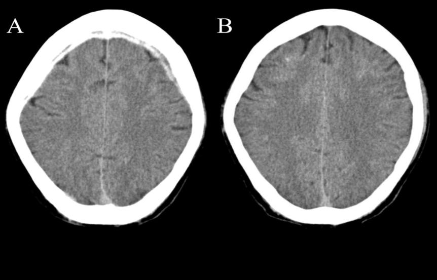 Figure 5: An axial brain CT scan shows; A-a subdural hemorrhage on one slice, and B-no abnormality was noted in all slices, except the slice “A” which indicates a motion artifact more than a subdural hemorrhage.