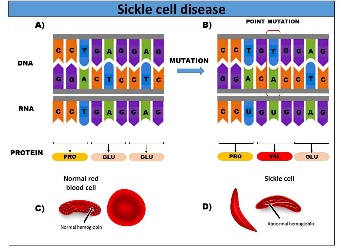 Figure 1: A) DNA, mRNA and amino acid sequence of normal hemoglobin. B) Mutation in DNA resulting in the replacement of Adenine (A) by Thymine (T) (GAG to GTG) in codon 6 of the mRNA, forming the amino acid valine. C) Red blood cell with normal hemoglobin. D) Sickle-shaped red blood cell, with a mutation in hemoglobin.