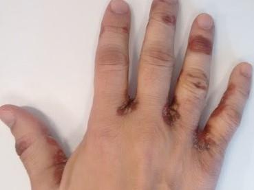 Figure 2: Dorsum of hand.