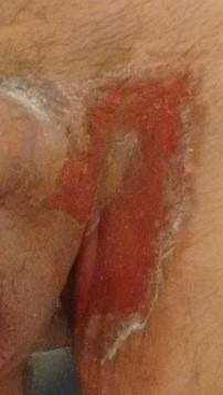 Figure 3: Groin involvement.