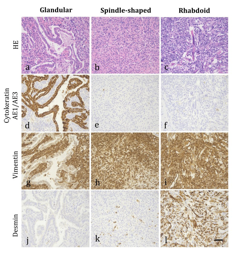 Figure 2: Pulmonary carcinosarcoma in a cat. Multifocal regions within the lung tumor display distinct morphologies: (a, d, g, j) glandular patterns, adjacent to spindle-shaped neoplastic cells; (b, e, h, k) spindle-shaped neoplastic cells forming interlacing bundles and streams; and (c, f, i, l) rhabdoid differentiation with elongated, brightly eosinophilic cytoplasm and rows of nuclei. Immunohistochemistry was performed to highlight these different morphologies, using the following antibodies: (d, e, f) anti-cytokeratin AE1/AE3; (g, h, i) anti-vimentin; and (j, k, l) anti-desmin. HE = hematoxylin and eosin. Scale bar = 50 µm.