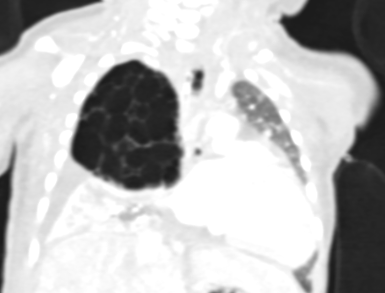 Figure 4: Chest CT, Coronal view, lung window: A large multi-loculated cystic lesion in right lung upper lobe. The cysts are mainly less than 2 cm in size. No dominant cyst is noted. Mediastinal shift towards the left side is noted.