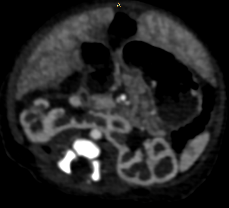 Figure 5: CT cuts through upper abdomen, axial view, and soft tissue window: lower poles of the kidneys are fused together anterior to abdominal aorta consistent with horseshoe kidneys.