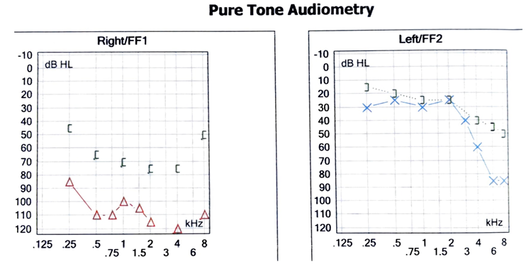Figure 1: Pure Tone Audiometry shows profound hearing loss on the right and mild sensorineural hearing loss with slope at high frequency on the left.