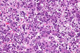 Figure 2: Atypical lobular hyperplasia delineating solid sheets of proliferating, dis-cohesive, monomorphic epithelial cells impregnated with pale pink cytoplasm, uniform elliptical nuclei and inconspicuous nucleoli [6].