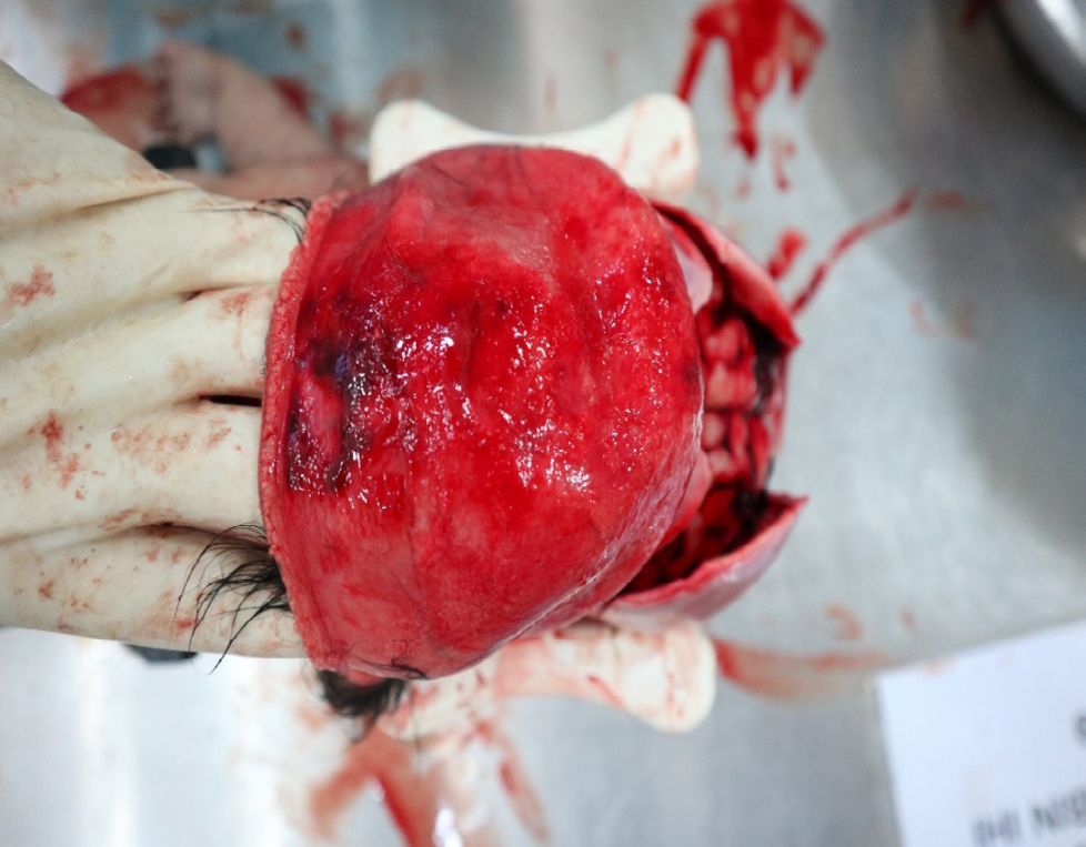 Figure 3: Presence of Subgaleal Haematoma.
