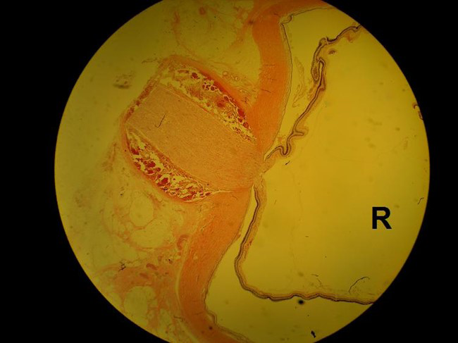 Figure 6: H&E Stain of the Eye Around Area of Insertion of the Nerve to the Eye with Surrounding Haemorrhage.