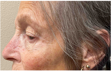 Figure 10: One week follow up after initial application of amniotic graft.