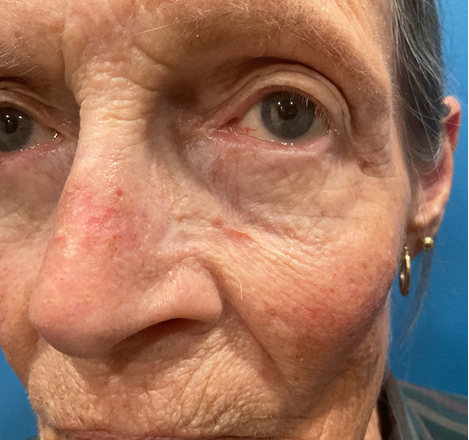 Figure 13: Eight week follow up after initial application of amniotic graft.