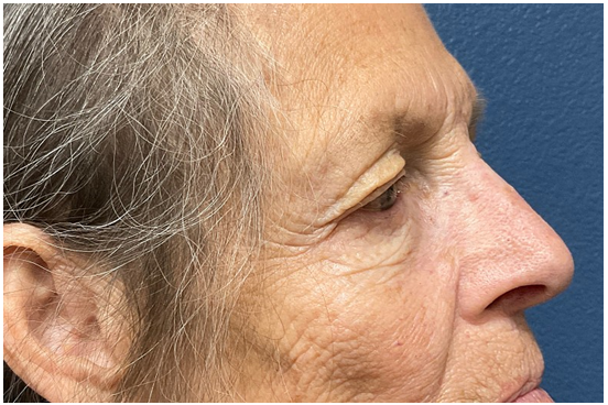 Figure 8: After the second Mohs surgery on the left lateral nasal sidewall in 2021, the patient allowed the wound to close through secondary intention and applied collagen powder to assist in the healing process. By 12 weeks, the wound had completely closed. The patient experienced no complications, and the result from the 17 month follow up is shown in Figure 9.