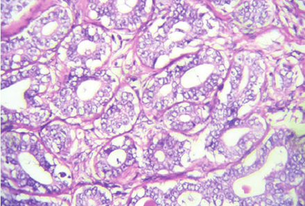 Figure 1: Duct adenoma demonstrating tubules and glandular articulations layered by columnar epithelial cells with minimal atypia and absent mitosis. Tubular and glandular articulations are embedded within a fibro- elastotic wall.