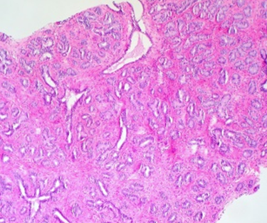 Figure 2: Duct adenoma constituted of glandular spaces lined by cuboidal to flattened or spindle shaped epithelial cells with minimal atypia and absent mitosis. Tubules and glandular spaces are enmeshed within a wall constituted of fibro-elastotic tissue.
