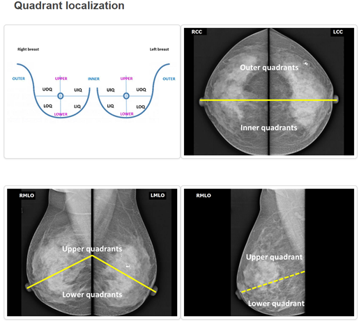 Figure 1: Mammogram images showing quadrant localization for mediolateral oblique (MLO) and craniocaudal (CC) views.