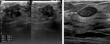Figure 10: Ultrasound images showing BIRADS- 5(probably malignant) and BIRADS-3(probably benign) lesions respectively.