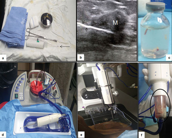 Figure 13: Breast biopsy. Panel (a–c) demonstrates prepared sterile tray with 14-gauge core biopsy needle (arrow in a) with sterile drapes and other accessory items needed. The cores obtained under USG guidance (arrows in b) have settled or are semi-floating in the container (c). Apparatus for vacuum-assisted biopsy (d–f) and the cores get collected in sample notch using vacuum (f) which is then shifted to the formalin bottle.