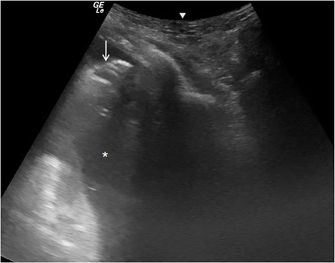Figure 16: Pleural effusion drainage: under ultrasound guidance, pigtail (arrow) has been placed within the pleural fluid (asterisk) in a patient with carcinoma breast who presented with sudden onset of breathlessness.