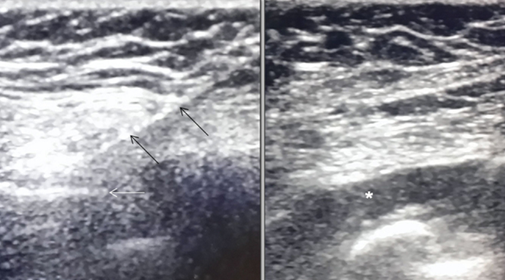 Figure 17: Serratous anterior block: using real time USG guidance, LP needle (black arrows) is inserted till it reaches the intercostal space or the rib (white arrow). The long-acting local anaesthetic agent is injected between the muscles (asterisk) with caution not to injure the pleura.