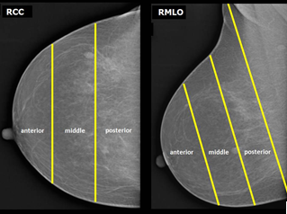 Figure 2: Localization of breast lesion in mammogram.