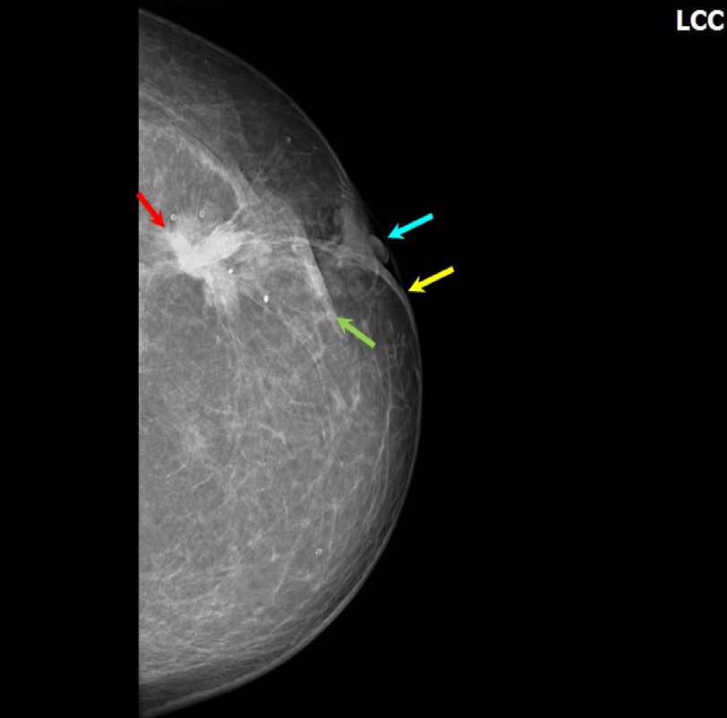 Figure 3: Spiculated high density lesion with skin , NAC thickening and retraction s/o malignancy-BIRADS-5.