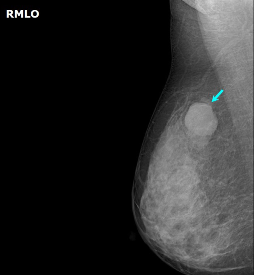 Figure 4: Well circumscribed oval density without architectural distortion likely s/o fibroadenoma- BIRADS-3.