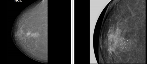 Figure 6: Malignant pleomorphic / amorphous calcifications.