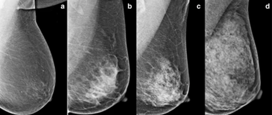 Figure 8: BI-RADS Density Types in Four Types. a) Almost entirely fat (Class A), b) Scattered fibroglandular densities (Class B), c) Heterogeneously dense (Class C), d) Extremely densities (Class D).