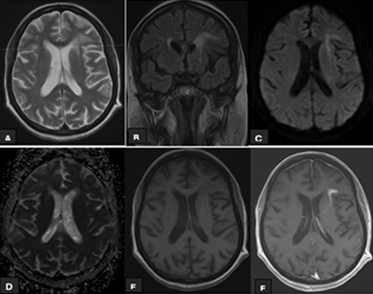 Figure 2: A 68 years old female presented to ED with drowsiness. MRI head (Figure A+B) Show hyperintense signals on T2 and FLAIR Sequence in left frontal lobe periventricular region, (Figure C+D) show diffusion restriction and (Figure E+F) Shoe heterogeneous enhancement in corresponding area. Bio-Fire panel detected Listeria Monocytogenes.