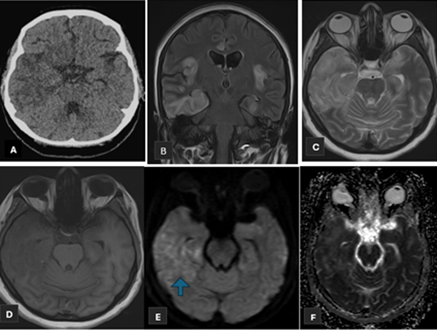 Figure 3: A 43 years old female with no known comorbids presented to ED with complaints of Headache, altered behavior and fever for the last 10 days. (Figure A) non-enhanced CT head shows low attenuation areas in bilateral temporal lobes, more on right side. MRI head (Figure B+C) show hyperintense signals on T2 and FLAIR sequences with corresponding hypointense signals on T1 sequence (Figure D) in bilateral temporal lobes and insular fissure. (Figure E+F) show patchy areas of different restriction. She underwent lumbar puncture and CSF DR showed predominant lymphocytic picture hence CSF HSV PCR was sent which showed HSV 1.