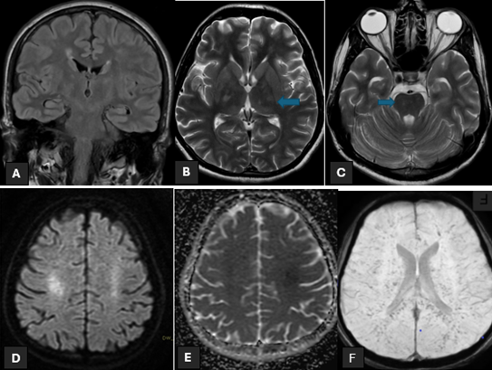 Figure 4: A 22 years old gentleman with no known comorbids presented to ED with history of fever and skin rash for 5days and acute loss of consciousness. MRI head (Figure A+B+C) show hyperintense signals in Bilateral Thalami And Brain Stem on T2 and FLAIR sequences. (Figure D+E) show diffusion restriction in bilateral centrum semiovale. (Figure F) shows micro hemorrhages in bilateral cerebral hemispheres. The patient underwent lumbar puncture and CSF DR showed predominant lymphocytic picture. Bio-Fire film array detected Varicella Zoster Virus.