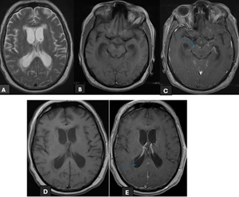 Figure 5: A 68 years old male known hypertensive presented to ED with complaints of headache and drowsiness. MRI head (Figure A) shows hydrocephalus with periventricular seepage. (Figure B+C) show marked Basilar meningeal enhancement. Marked by arrow (Figure C+D) show enhancement of ependymal lining marked by arrow. Patient’s lumbar puncture was done showed infective picture. Bio-Fire film array detected Cryptococcus neoformans.
