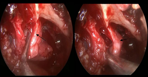 Figure 4: Endonasal Vision with Endoscopes: Dissection and Luxation of the Lacrimal Duct to Perform the Prelacrimal Maxillary Osteotomy (Arrows), when there is a Small Space between FPM an the NLD.