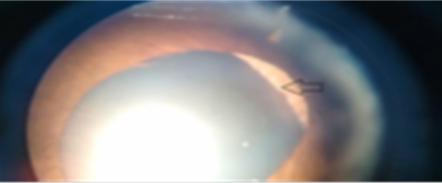 Figure 5: Infero-temporally displaced lens OS. The first case (Marfan’s syndrome) was started on tablet Ramipril 25mg OD, tablet Revolol 50mg OD with extensive physiotherapy and joint stretching exercises. She was advised regular follow-up for cardiac monitoring. The second case (Ectopia lentis et pupillae) was devoid of any systemic involvement and required only visual rehabilitation. Visual rehabilitation by means of spectacle correction was resorted to with good acceptance by the patient in both cases. On follow-up visits, parents reported substantial academic improvement and satisfaction on part of the child.