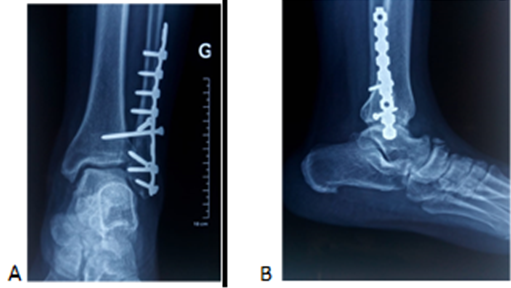 Figure 1: ** Osteosynthesis of a bimalleoar + fracture. Tricortical syndesmosis screw. **Functional Results:** Functional outcome based on the AOFAS score was excellent in 17 patients (21%) and good in